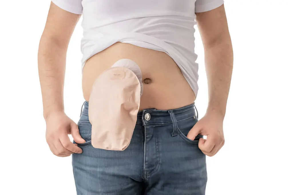 What Is an Ostomy Bag and How Does It Work?