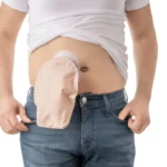 What Is an Ostomy Bag and How Does It Work?