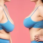 Can Breast Reduction Help with Posture Problems
