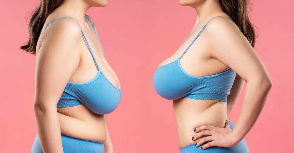 Can Breast Reduction Help with Posture Problems