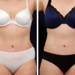 What No One Tells You About Getting Liposuction