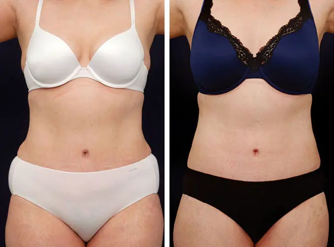 What No One Tells You About Getting Liposuction